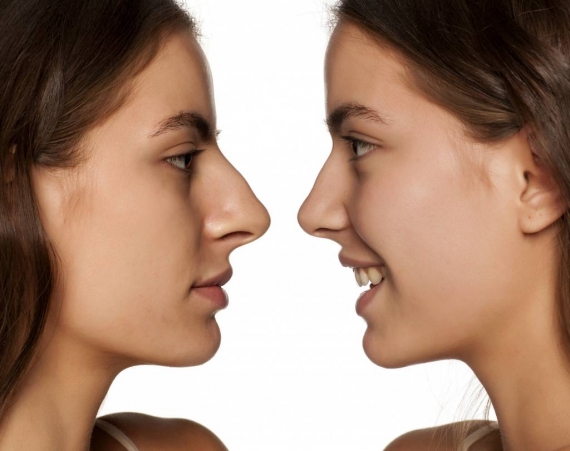 prix rhinoplastie